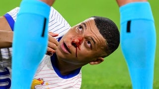 Der Franzose Kylian Mbappé erlitt bei der EM 2024 im Spiel gegen Österreich einen Nasenbeinbruch, nachdem er mit Kevin Danso kollidiert war: Hochleistungssportler haben ein 20-fach höheres Risiko sich zu verletzen als andere Sportler. 