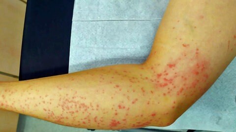 Hautausschlag auf dem Arm: Die Wasserqualität in EU-Badeseen wird regelmäßig kontrolliert. Saugwürmer-Larven, so genannte Zerkarien, verursachen oft einen juckenden Hautausschlag. (Archivbild)