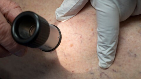 Ein Hautarzt untersucht die Haut eines Patienten. (Symbolbild)