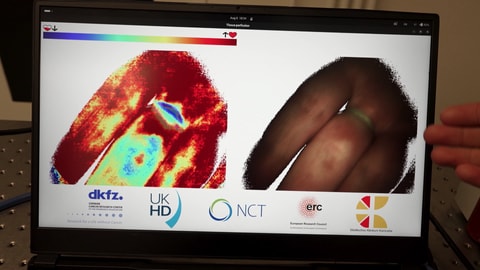 Wärmebild-Aufnahme einer Hand. Um eine Sepsis früher zu erkennen, kann ein neues Diagnoseinstrument vom DKFZ aus Heidelberg mit einem KI-Foto Blutgefäße im Körper untersuchen. 