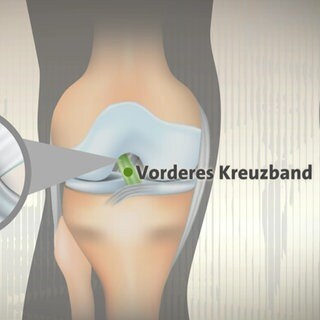 Grafik, die anzeigt, wo das Kreuzband im Knie verläuft. Wird das Knie falsch belastet, kann das Kreuzband reißen.