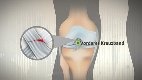Grafik, die anzeigt, wo das Kreuzband im Knie verläuft. Wird das Knie falsch belastet, kann das Kreuzband reißen.