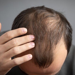 Mann mit Geheimratsecken und dünnem Haarwuchs. Haarverlust betrifft Männer und Frauen, die Ursachen sind vielfältig. Haarausfall kann auch zu psychischen Problemen führen. Was helfen kann – von Koffein bis Transplantation.