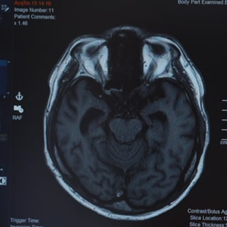 Alzheimer Diagnose