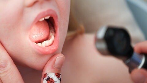 Mit einem Otoskop untersucht eine Kinderärztin den Mund und Hals eines Mädchens. Die Zahl der Keuchhusten-Fälle in Baden-Württemberg lag 2024 um ein vielfaches höher als in früheren Jahren.
