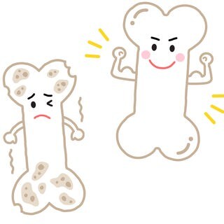 Osteoporose (Illustration): kranker "trauriger" Knochen und gesunder "fröhlicher" Knochen: Osteoporose betrifft in Deutschland rund 5,7 Millionen Menschen, vor allem Frauen nach der Menopause. Aber auch Männer kann es treffen. 