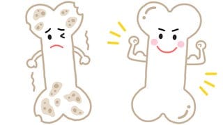 Osteoporose (Illustration): kranker "trauriger" Knochen und gesunder "fröhlicher" Knochen: Osteoporose betrifft in Deutschland rund 5,7 Millionen Menschen, vor allem Frauen nach der Menopause. Aber auch Männer kann es treffen. 