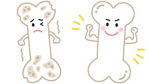 Osteoporose (Illustration): kranker "trauriger" Knochen und gesunder "fröhlicher" Knochen: Osteoporose betrifft in Deutschland rund 5,7 Millionen Menschen, vor allem Frauen nach der Menopause. Aber auch Männer kann es treffen. 
