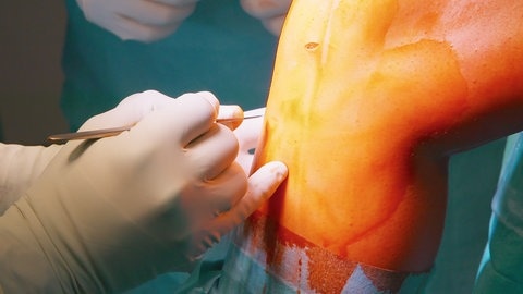 Kreuzbandriss: So hilft eine Operation