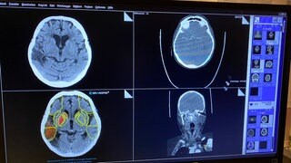 Die "Stroke-Unit" im Klinikum Ludwigshafen