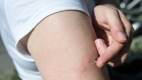 Eine Frau schmiert ein kühlendes und juckreizhemmendes Gel auf die Mueckenstiche an ihrem Arm.