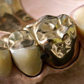 Eine Prothese mit Zahngold.