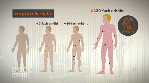 Vier Piktogramme von Menschen unterschiedlich, heller Hautfarbe und unterschiedlich vielen Muttermalen stehen nebeneinander. Darüber stehen die Risikoerhöhung geschrieben: 7-fach erhöht, 20-fach erhöht. 120-fach erhöht. 