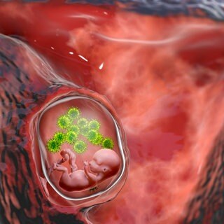 Embryo wird im Mutterleib mit Viren infiziert (Grafik): Bei einer Infektion mit dem Zytomegalie-Virus in der Schwangerschaft kann das Kind schwerwiegende Schäden davontragen. 