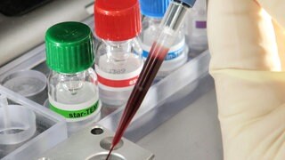 Blutuntersuchung im Labor - viele Fälle von Sepsis werden zu spät erkannt und enden tödlich.