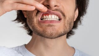 Mann zeigt Entzündung der Mundschleimhaut 