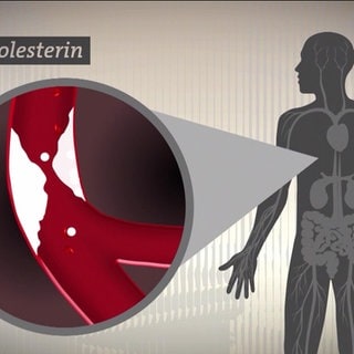 Verstopfte Arterie