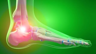 Arthrose im Fuß: Unter Arthrose versteht man eine primär verschleißbedingte Gelenkerkrankung, die prinzipiell alle Gelenke betreffen kann und verschiedene Ursachen hat