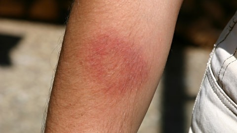 Ein roter Ring auf der Haut deutet auf eine Borreliose-Infektion hin, die durch einen Zeckenbiss ausgelöst wurde.