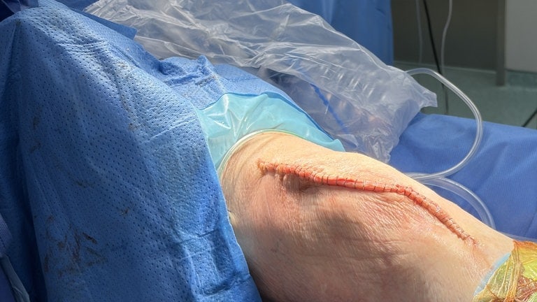 Schon jetzt ist das Knie wieder voll beweglich. Bereits am Tag nach der OP kann der Patient das Knie voll belasten. 