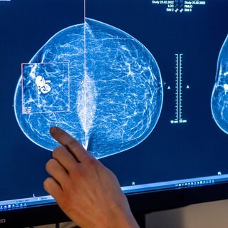 Solche radiologischen Aufnahmen der Brust untersucht die KI-Software an der Oberschwabenklinik auf Hinweise auf Brustkrebs. (Symbolbild)