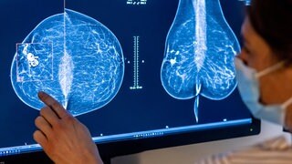 Solche radiologischen Aufnahmen der Brust untersucht die KI-Software an der Oberschwabenklinik auf Hinweise auf Brustkrebs. (Symbolbild)