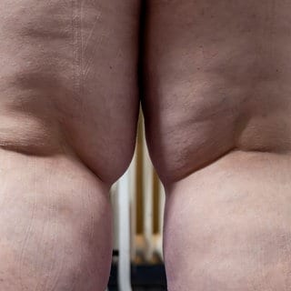 Kniekehlen einer Frau, die an Lipödem leidet: woran Betroffene die Erkrankung erkennen und welche Therapien helfen.