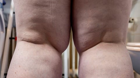 Kniekehlen einer Frau, die an Lipödem leidet: woran Betroffene die Erkrankung erkennen und welche Therapien helfen.